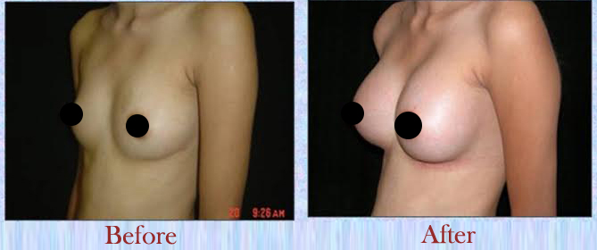 Breast implant surgery cost in Delhi